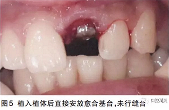 前牙即刻種植并個(gè)性化基臺(tái)美學(xué)修復(fù)