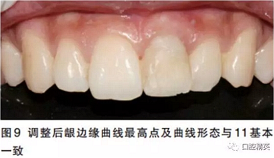 前牙即刻種植并個(gè)性化基臺(tái)美學(xué)修復(fù)