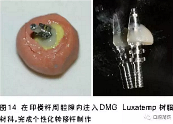 前牙即刻種植并個(gè)性化基臺(tái)美學(xué)修復(fù)