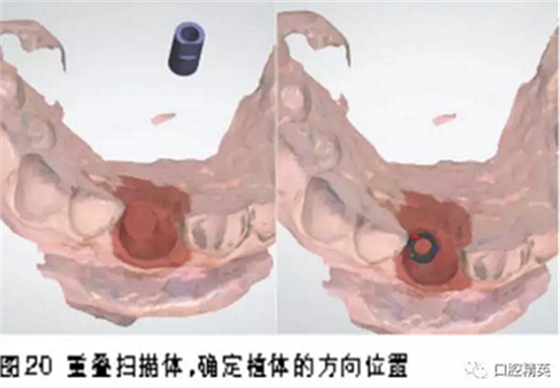 前牙即刻種植并個(gè)性化基臺(tái)美學(xué)修復(fù)