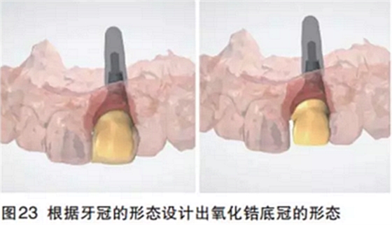 前牙即刻種植并個(gè)性化基臺(tái)美學(xué)修復(fù)