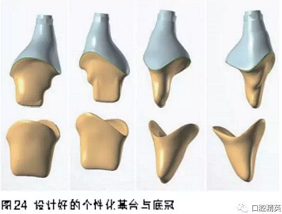 前牙即刻種植并個(gè)性化基臺(tái)美學(xué)修復(fù)