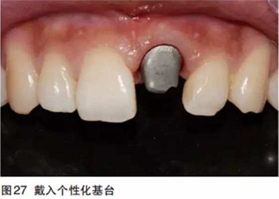 前牙即刻種植并個(gè)性化基臺(tái)美學(xué)修復(fù)