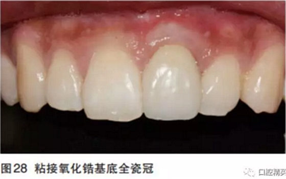 前牙即刻種植并個(gè)性化基臺(tái)美學(xué)修復(fù)