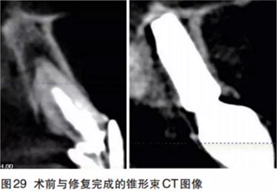 前牙即刻種植并個(gè)性化基臺(tái)美學(xué)修復(fù)