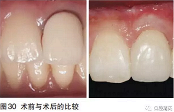 前牙即刻種植并個(gè)性化基臺(tái)美學(xué)修復(fù)