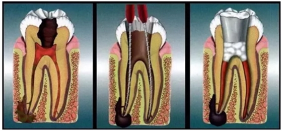 根管治療時(shí)四種殘髓處理方法