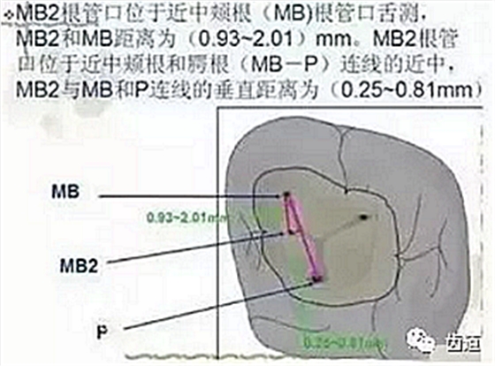 根管治療常見的難點與解決方案