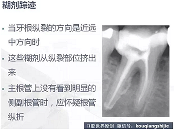 牙根縱裂