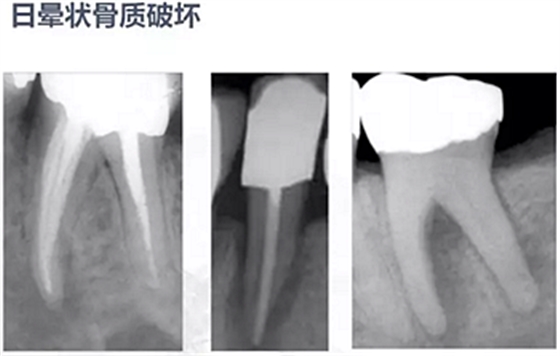 牙根縱裂