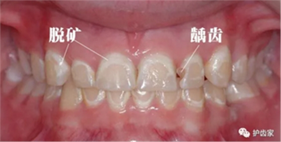 脫礦與齲齒的關(guān)系