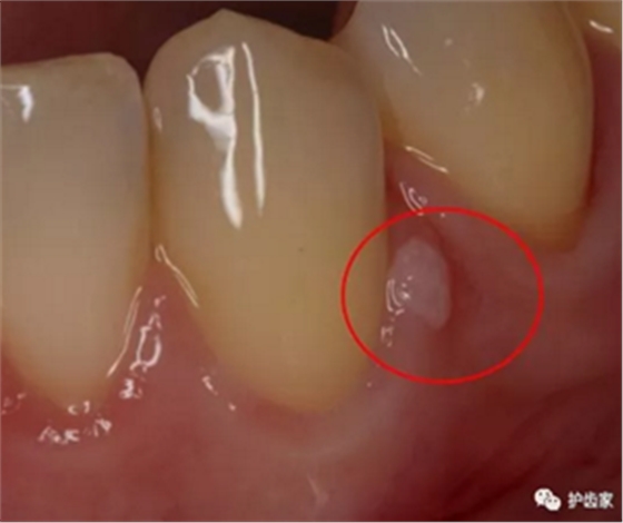 牙齦上長膿包，擠掉后還反復(fù)長出，怎么回事？