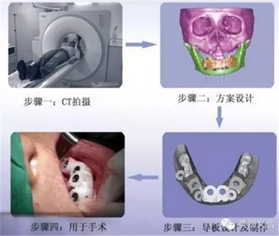 牙技術(shù)丨牙科種植導板在臨床中的應(yīng)用