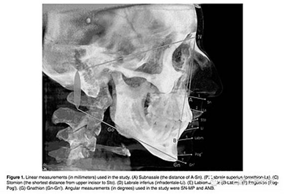 正畸文獻(xiàn)閱讀--使用CBCT評估具有不同垂直生長模式的成人患者的面下1/3的軟組織厚度值