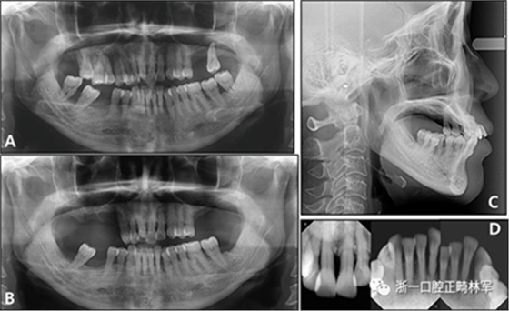 文獻優(yōu)秀正畸病例賞析--多顆牙齒缺失的牙周炎患者的跨學科綜合治療