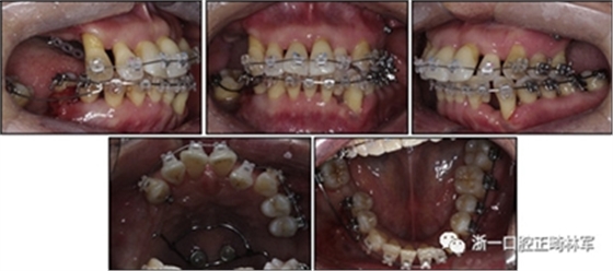 文獻優(yōu)秀正畸病例賞析--多顆牙齒缺失的牙周炎患者的跨學科綜合治療