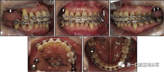 文獻優(yōu)秀正畸病例賞析--多顆牙齒缺失的牙周炎患者的跨學科綜合治療