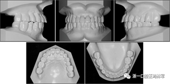 文獻優(yōu)秀正畸病例賞析--多顆牙齒缺失的牙周炎患者的跨學科綜合治療