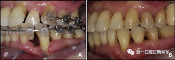 文獻優(yōu)秀正畸病例賞析--多顆牙齒缺失的牙周炎患者的跨學科綜合治療
