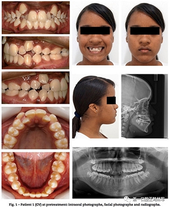 文獻(xiàn)優(yōu)秀正畸病例賞析--同卵雙胞胎使用自鎖托槽和傳統(tǒng)托槽正畸治療比較