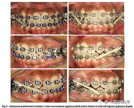 文獻(xiàn)優(yōu)秀正畸病例賞析--同卵雙胞胎使用自鎖托槽和傳統(tǒng)托槽正畸治療比較