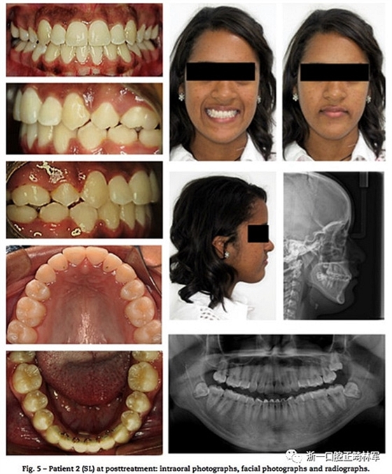文獻(xiàn)優(yōu)秀正畸病例賞析--同卵雙胞胎使用自鎖托槽和傳統(tǒng)托槽正畸治療比較