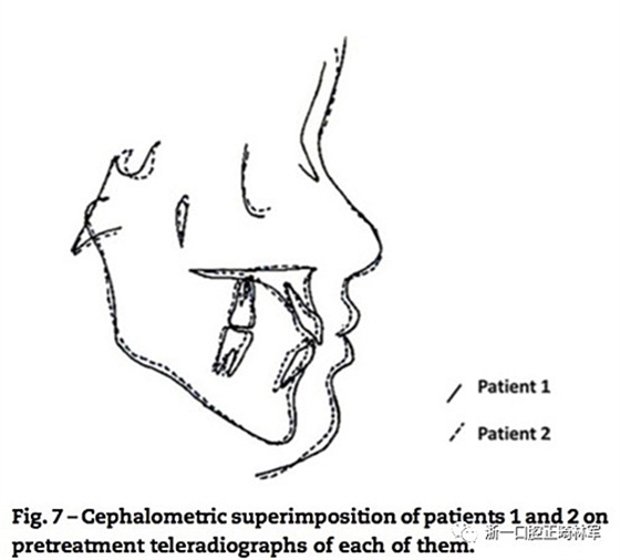 文獻(xiàn)優(yōu)秀正畸病例賞析--同卵雙胞胎使用自鎖托槽和傳統(tǒng)托槽正畸治療比較