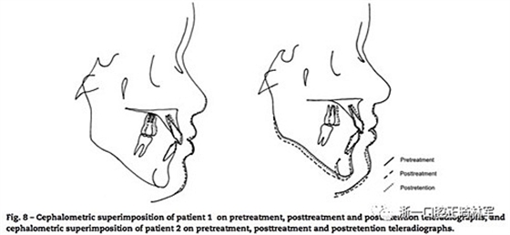 文獻(xiàn)優(yōu)秀正畸病例賞析--同卵雙胞胎使用自鎖托槽和傳統(tǒng)托槽正畸治療比較