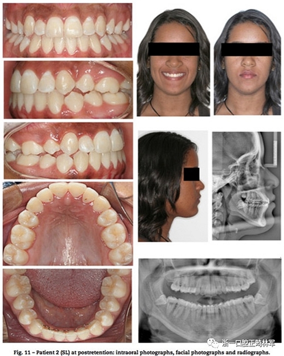 文獻(xiàn)優(yōu)秀正畸病例賞析--同卵雙胞胎使用自鎖托槽和傳統(tǒng)托槽正畸治療比較