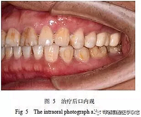 利用壓膜式活動(dòng)矯治器壓入下頜第一、第二磨牙1例