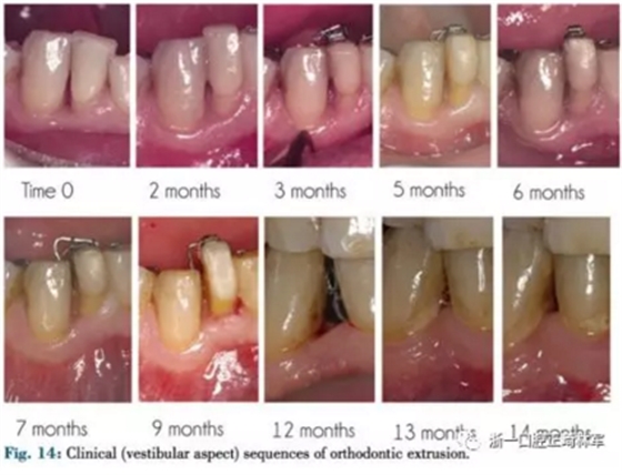 文獻(xiàn)優(yōu)秀正畸病例賞析--正畸牙周聯(lián)合治療方法病例介紹