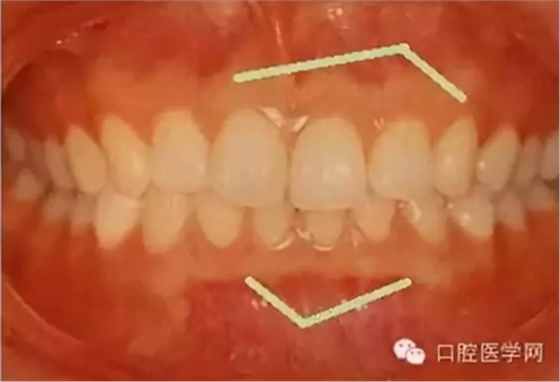 牙床骨質(zhì)突起的原因和處理措施