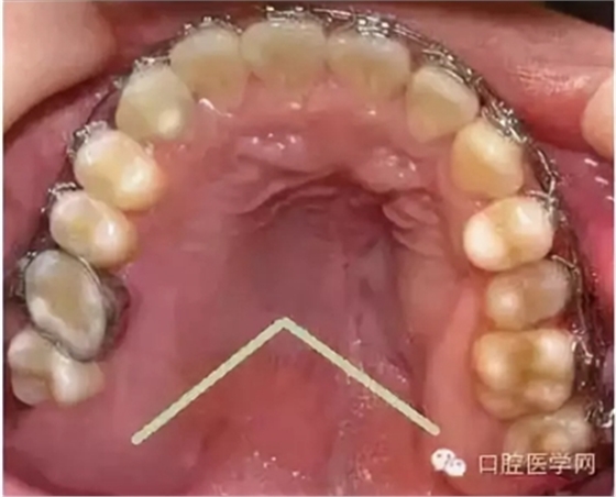 牙床骨質(zhì)突起的原因和處理措施