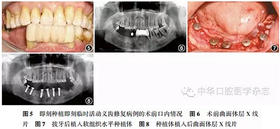 【專家筆談】即刻種植治療方案的評(píng)估與實(shí)施