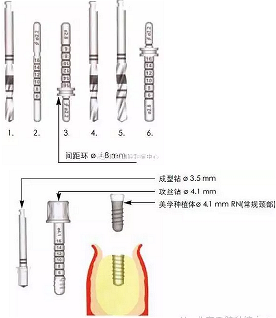 Sraumann種植系統(tǒng)外科操作流程