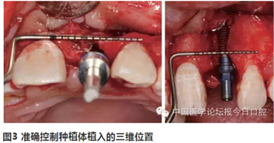 手把手教你做種植軟組織成形