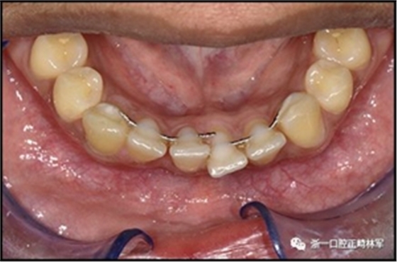 正畸文獻(xiàn)閱讀--固定舌側(cè)保持器作用下意外的牙齒移動(dòng)
