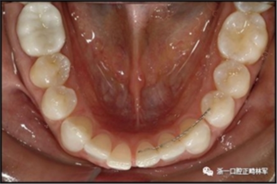 正畸文獻(xiàn)閱讀--固定舌側(cè)保持器作用下意外的牙齒移動(dòng)