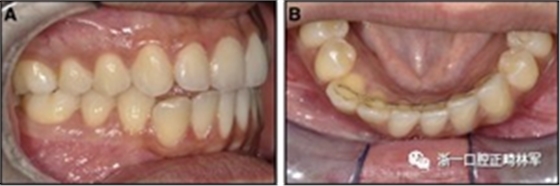 正畸文獻(xiàn)閱讀--固定舌側(cè)保持器作用下意外的牙齒移動(dòng)