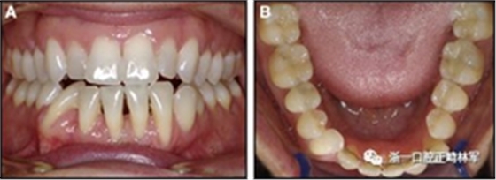 正畸文獻(xiàn)閱讀--固定舌側(cè)保持器作用下意外的牙齒移動(dòng)