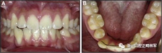 正畸文獻(xiàn)閱讀--固定舌側(cè)保持器作用下意外的牙齒移動(dòng)