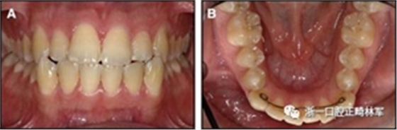 正畸文獻(xiàn)閱讀--固定舌側(cè)保持器作用下意外的牙齒移動(dòng)