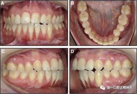 正畸文獻(xiàn)閱讀--固定舌側(cè)保持器作用下意外的牙齒移動(dòng)