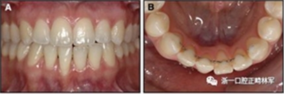正畸文獻(xiàn)閱讀--固定舌側(cè)保持器作用下意外的牙齒移動(dòng)