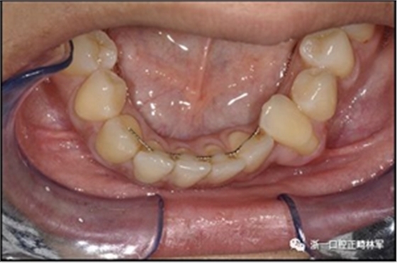 正畸文獻(xiàn)閱讀--固定舌側(cè)保持器作用下意外的牙齒移動(dòng)