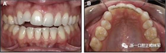 正畸文獻(xiàn)閱讀--固定舌側(cè)保持器作用下意外的牙齒移動(dòng)