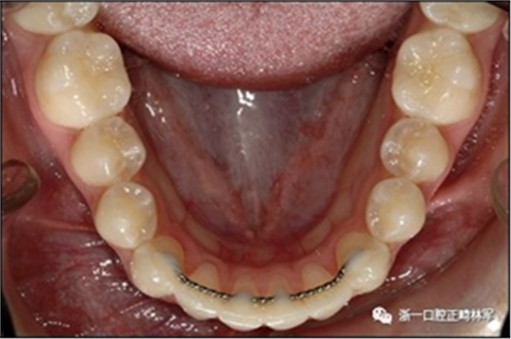 正畸文獻(xiàn)閱讀--固定舌側(cè)保持器作用下意外的牙齒移動(dòng)