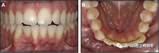 正畸文獻(xiàn)閱讀--固定舌側(cè)保持器作用下意外的牙齒移動(dòng)