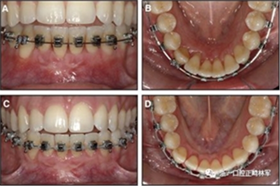 正畸文獻(xiàn)閱讀--固定舌側(cè)保持器作用下意外的牙齒移動(dòng)