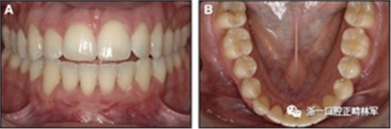 正畸文獻(xiàn)閱讀--固定舌側(cè)保持器作用下意外的牙齒移動(dòng)